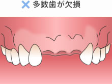 多数歯が欠損