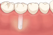 インプラント