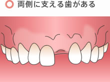 両側に支える歯がある