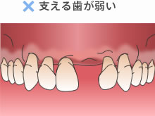 支える歯が弱い