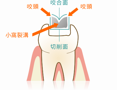 詰め物：インレーの断面図