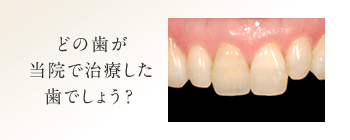 どの歯が当院で治療した歯でしょう？